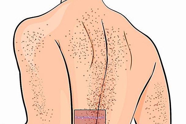 Trombotisk trombocytopen purpura: hvad det er, årsager og behandling