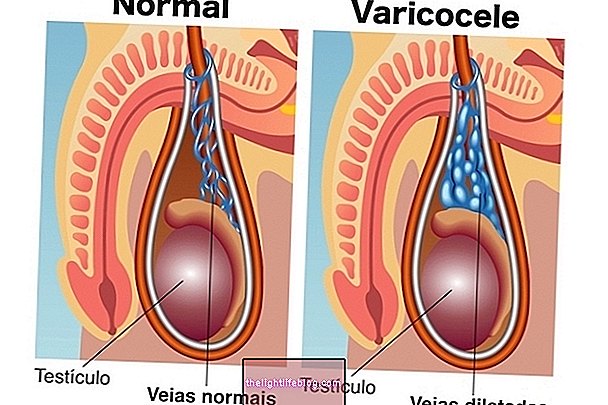 Varicocele hos barn och ungdomar