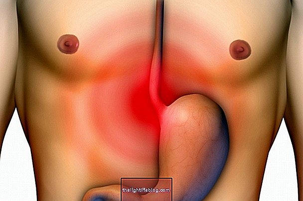 Achalasia: nó là gì, triệu chứng và cách điều trị