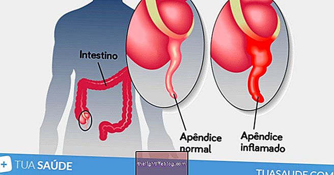 Apendicīts: kas tas ir, simptomi un ārstēšana