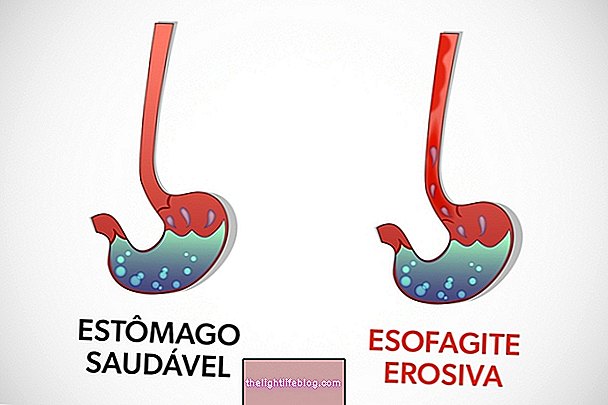 Oesophagite érosive: qu'est-ce que c'est, traitement et classification de Los Angeles