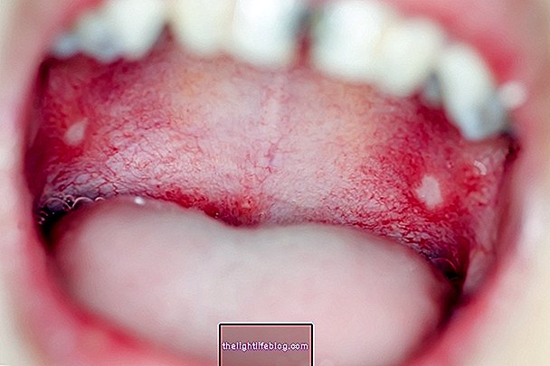 Mucositis: hvad det er, symptomer og behandlingsmuligheder