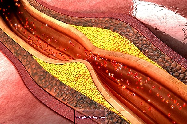 Atherosclerosis: mi ez, tünetei, okai és kezelése