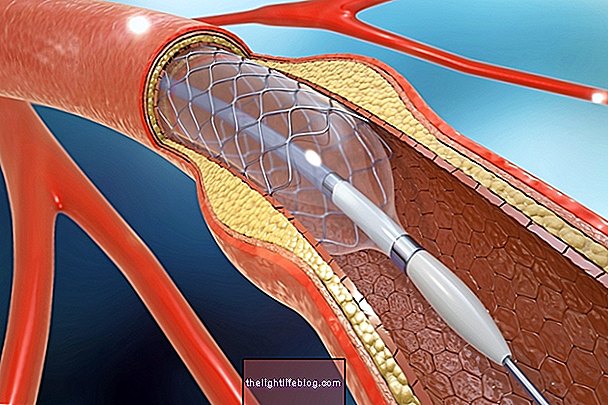 Stent: mi ez, mire való és milyen fő típusok