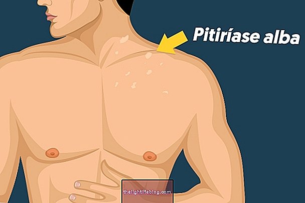 Какво е Pityriasis alba и как да се лекува