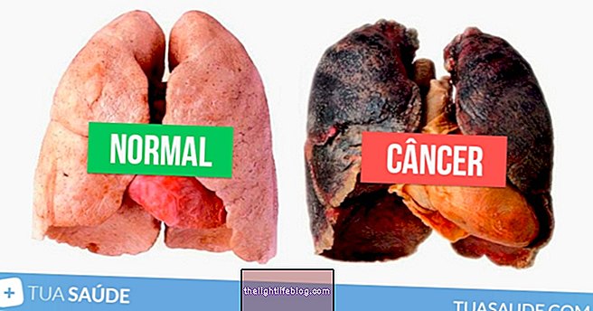 Lung cancer: cure and treatment options