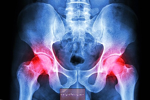 Kaip nustatyti ir gydyti polymyalgia rheumatica