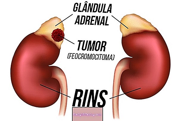 Cách xác định và điều trị u pheochromocytoma