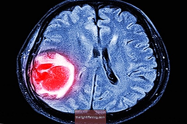 Glioblastoma multiforme: semptomlar, tedavi ve hayatta kalma