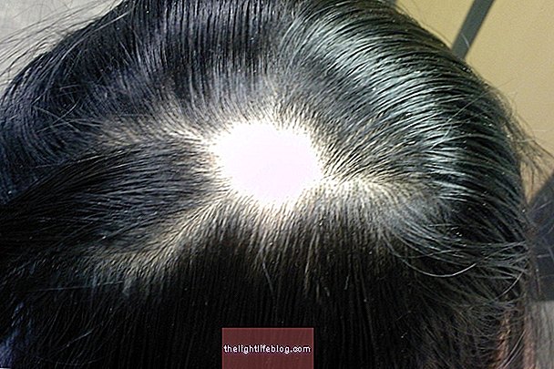 Alopecia areata: מה זה, סיבות אפשריות וכיצד לזהות