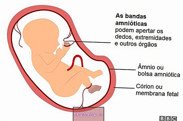 Što je sindrom amnionske vrpce, uzroci i kako liječiti