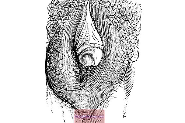 Pseudohermaphroditism: hvad det er, egenskaber og behandling