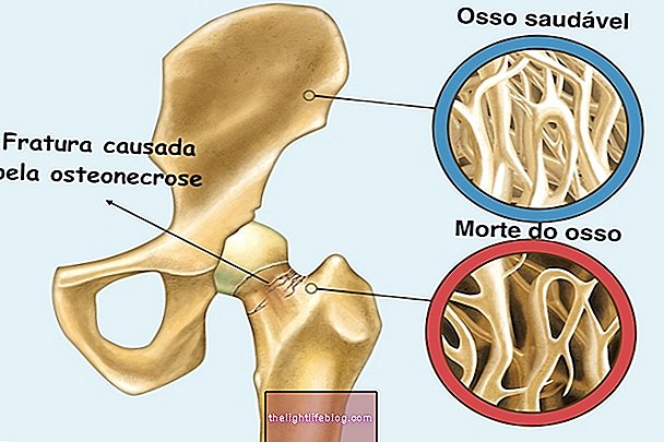 Ce este Osteonecroza și cum se identifică