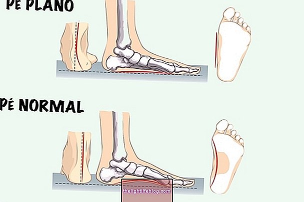 Cos'è il piede valgo e cosa fare per correggerlo