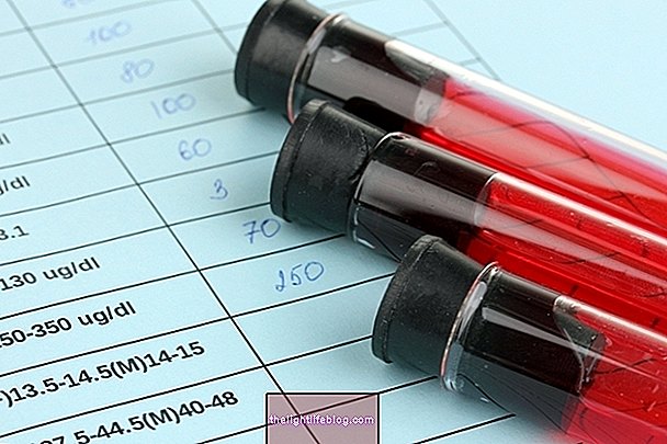 Paroxysmal hemoglobinuria ออกหากินเวลากลางคืน: มันคืออะไรและทำการวินิจฉัยได้อย่างไร