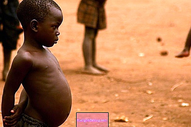 Kwashiorkor: Nedir, neden olur ve nasıl tedavi edilir?