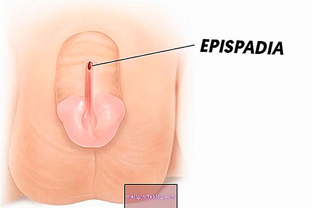 Epispadiaとは何ですか？それをどのように扱うか