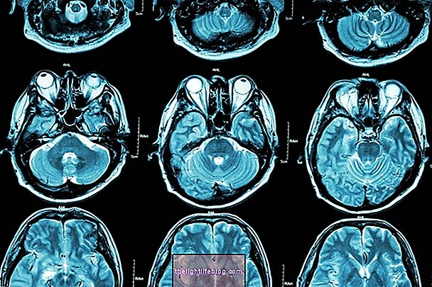 Arnold-Chiari syndrom: hva det er, typer, symptomer og behandling