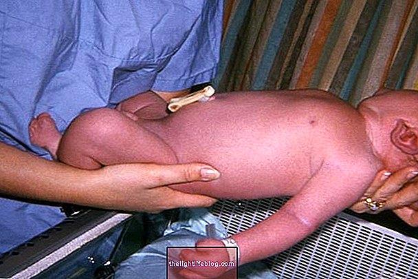 Pfeiffer syndrome คืออะไรประเภทการวินิจฉัยและการรักษา