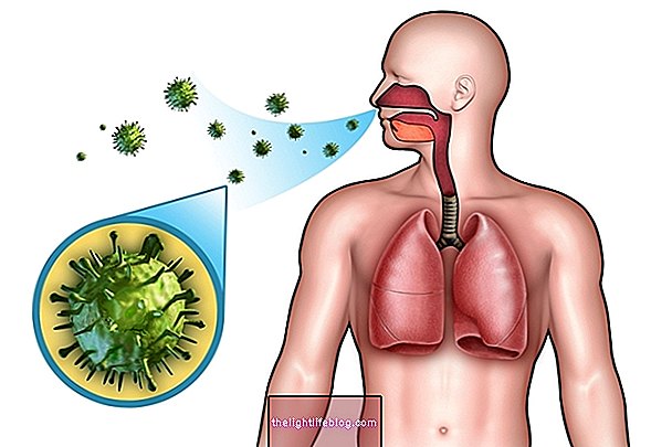 Pneumonia komunitas: apa itu, gejala dan pengobatannya