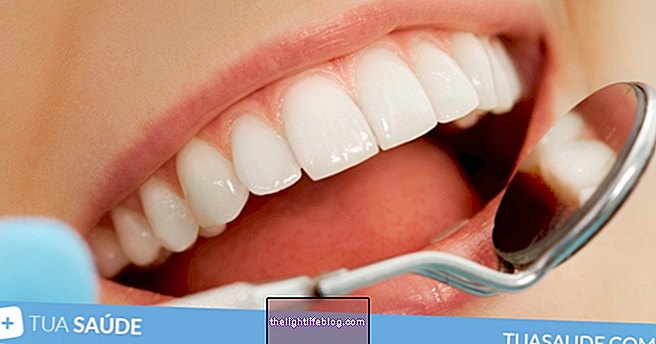 4 opzioni di trattamento per sbiancare i denti