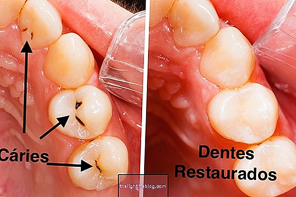 Caries: apakah itu, gejala, sebab dan rawatan