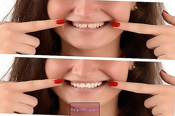 Veneers nha khoa làm bằng nhựa hoặc sứ: ưu và nhược điểm