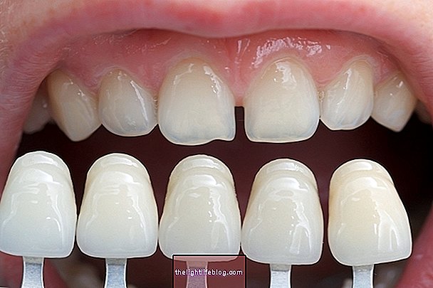 Diastema nedir ve nasıl tedavi edilir?