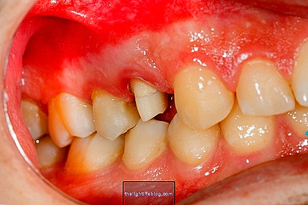 ما هو وكيفية علاج التهاب اللثة التقرحي الناخر