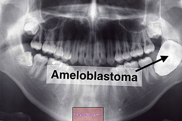 Apakah Ameloblastoma dan Cara Mengubatinya