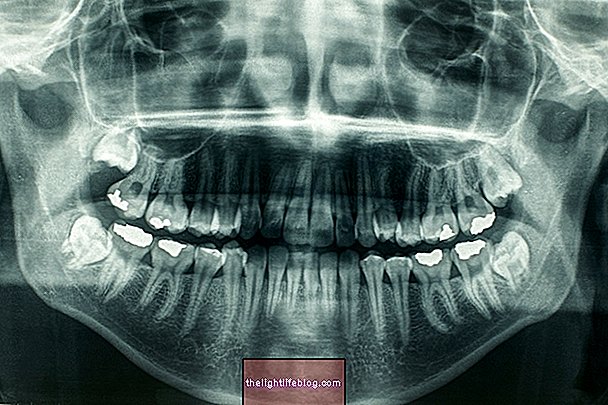 Panoramic oral X-ray (Orthopantomography): what is it for and how it is done