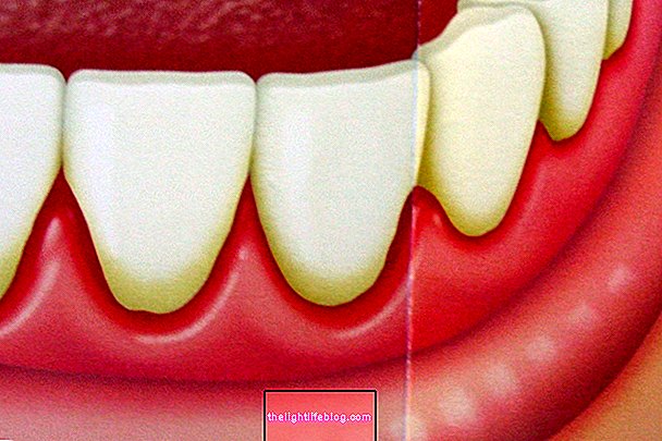 علامات وأعراض التهاب اللثة