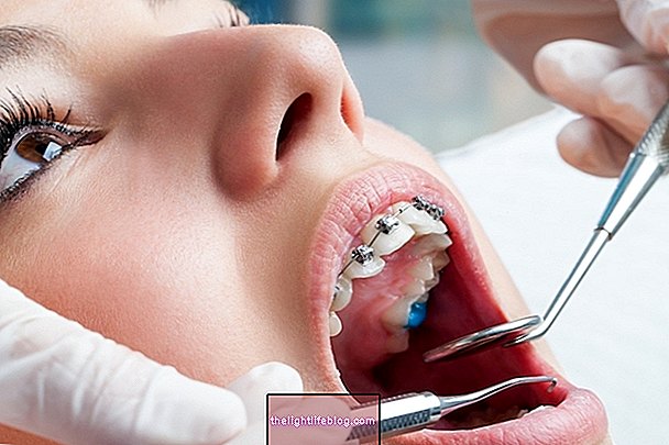 Types of dental malocclusion and how to treat