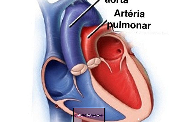 Zdravljenje transpozicije velikih arterij