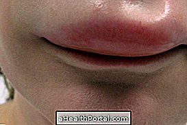 Angioedema nasıl tanımlanır ve tedavi edilir