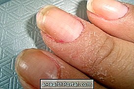 Dermatitis Kontak Irritant