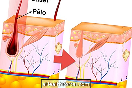 Loại bỏ lông bằng laser ở háng: cách thức hoạt động và số phiên cần làm