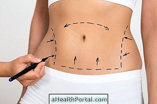 Hvordan gjenoppretter abdominoplasty?