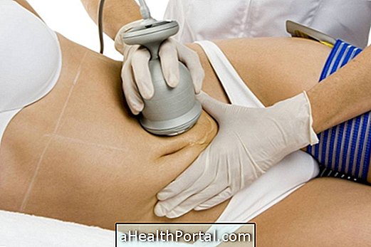 Lipocavitation adalah prosedur estetik yang hasilnya dapat diperhatikan secara progresif, yang berfungsi untuk menghilangkan lemak setempat dalam perut, paha, tulang belakang dan belakang, melalui alat ultrasound yang membantu menghancurkan lemak terkumpul. Prosedur ini, yang juga dikenali sebagai lipo tanpa pembedahan, tidak menyakitkan dan membantu kehilangan kelantangan, mendapatkan badan yang lebih berbentuk dan didefinisikan, selain membantu memperbaiki penampilan kulit dan menurunkan selulit