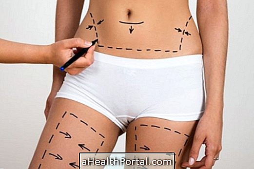 איך הוא liposuction לאחר הניתוח