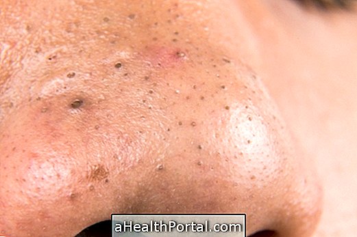 How to remove blackheads and pimples from the nose