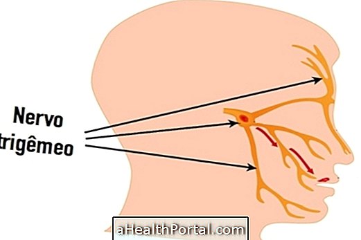 โรคประสาท trigeminal: สิ่งที่เป็นอาการหลักและวิธีการรักษา