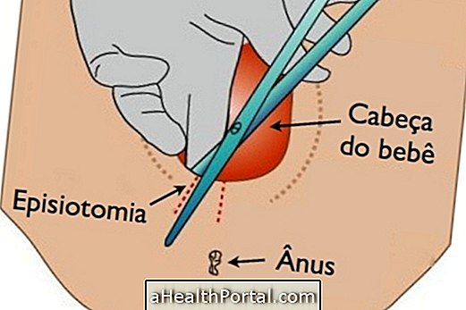 כיצד לטפל episiotomy לאחר הלידה