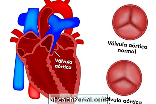 Co způsobuje bikuspidální aortální ventil a jak ho léčit