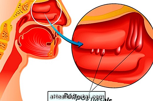 Kaj je zdravilo Nasal Polyp in kako ga zdraviti