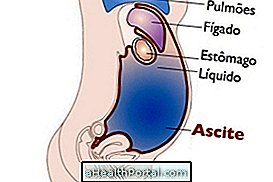 ما هو Ascite