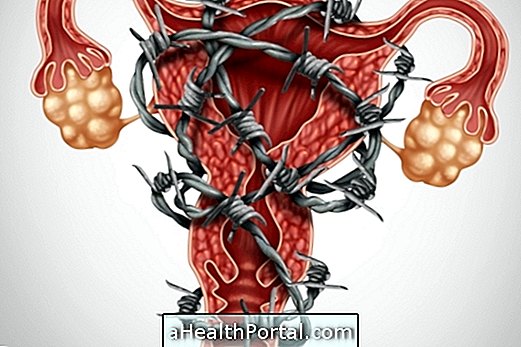 Endometriozis Hakkında Tüm Şüpheleri Netleştirin