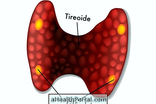 Wat is Hypoparathyroidism en hoe te identificeren