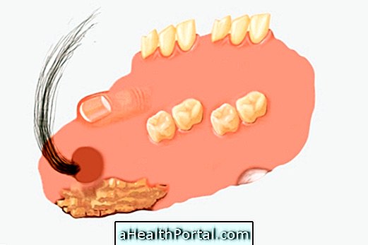 Teratoma: ne ve nasıl tedavi edilir