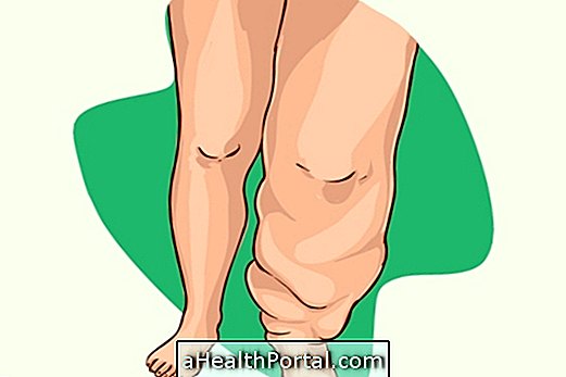 Τι είναι το Lymphedema και πώς να το θεραπεύσετε